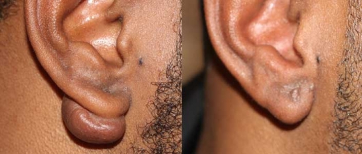 Photo by <br />
<b>Notice</b>:  Undefined index: user in <b>/home/www/activeuser/data/www/vaplace.com/core/views/default/photos.php</b> on line <b>128</b><br />
. Picture for Keloid Treatment Center in New York City, New York, United States - Point of interest, Establishment, Health, Doctor