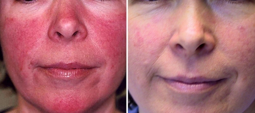 Rosacea NYC in New York City, New York, United States - #3 Photo of Point of interest, Establishment, Health, Doctor