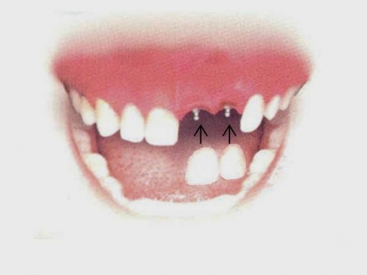 Sanford N. Gerber, DDS Mini Dental Implants in Elmont City, New York, United States - #2 Photo of Point of interest, Establishment, Health, Dentist