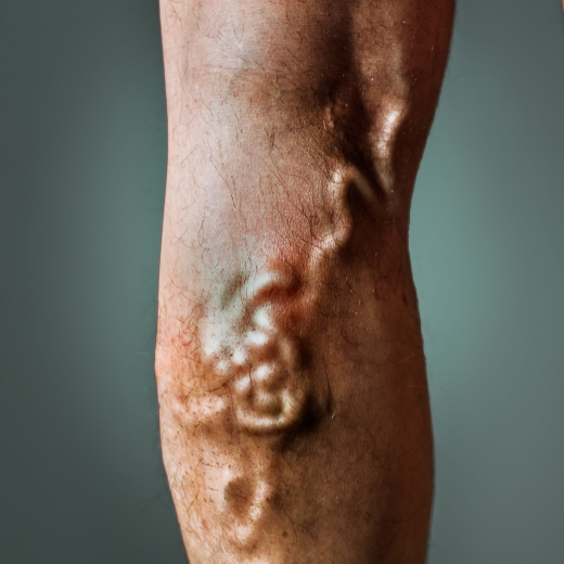 Advance Varicose Vein Treatment: Ron E Lev MD in New York City, New York, United States - #1 Photo of Point of interest, Establishment, Health, Doctor