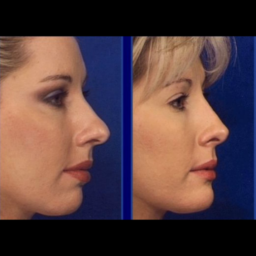 Photo by <br />
<b>Notice</b>:  Undefined index: user in <b>/home/www/activeuser/data/www/vaplace.com/core/views/default/photos.php</b> on line <b>128</b><br />
. Picture for Park Avenue Rhinoplasty in New York City, New York, United States - Point of interest, Establishment, Health, Doctor