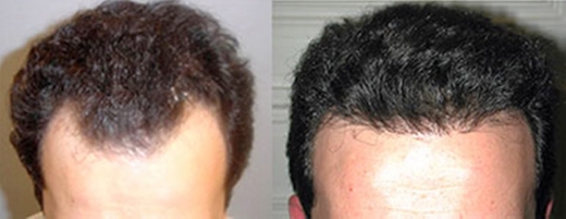 Photo by <br />
<b>Notice</b>:  Undefined index: user in <b>/home/www/activeuser/data/www/vaplace.com/core/views/default/photos.php</b> on line <b>128</b><br />
. Picture for New York Hair Transplantation in New York City, New York, United States - Point of interest, Establishment, Health, Doctor, Hair care