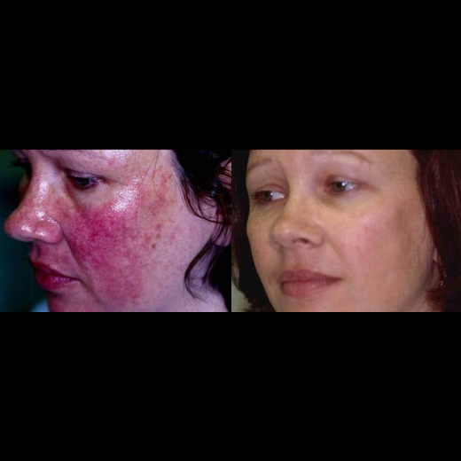 Rosacea NYC in New York City, New York, United States - #4 Photo of Point of interest, Establishment, Health, Doctor