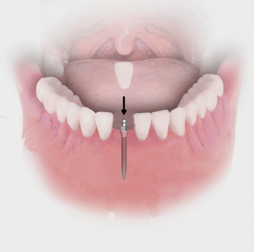 Sanford N. Gerber, DDS Mini Dental Implants in Elmont City, New York, United States - #1 Photo of Point of interest, Establishment, Health, Dentist
