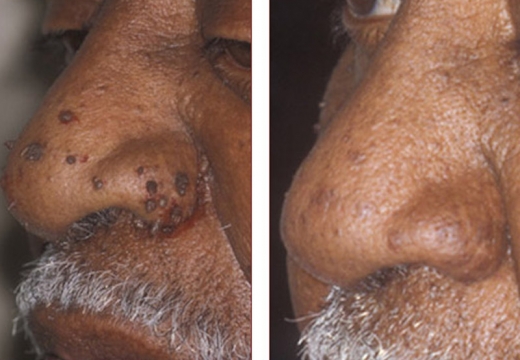 Dermatosis Papulosa Nigra NYC in New York City, New York, United States - #3 Photo of Point of interest, Establishment, Health, Doctor