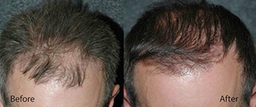 Photo by <br />
<b>Notice</b>:  Undefined index: user in <b>/home/www/activeuser/data/www/vaplace.com/core/views/default/photos.php</b> on line <b>128</b><br />
. Picture for New York Hair Transplantation in New York City, New York, United States - Point of interest, Establishment, Health, Doctor, Hair care