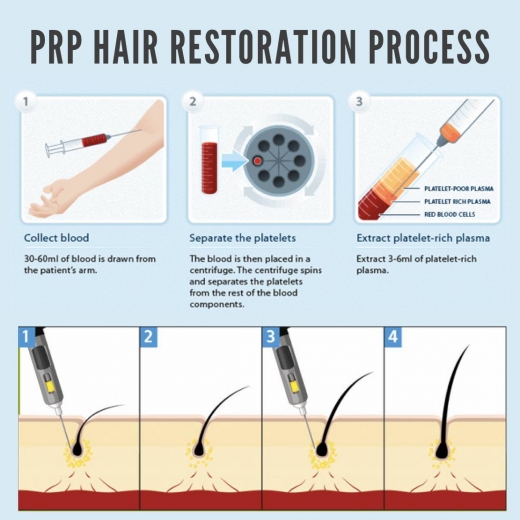 PRP Hair MD New Jersey in Englewood Cliffs City, New Jersey, United States - #3 Photo of Point of interest, Establishment, Health, Hair care