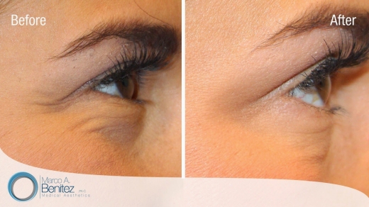 Photo by <br />
<b>Notice</b>:  Undefined index: user in <b>/home/www/activeuser/data/www/vaplace.com/core/views/default/photos.php</b> on line <b>128</b><br />
. Picture for Premier Aesthetics- Astoria Botox Dermal Filler Plasma PRP in Queens City, New York, United States - Point of interest, Establishment, Health, Spa
