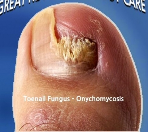 Photo by OnychoLase ® Laser Nail Center for OnychoLase ® Laser Nail Center